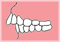 出っ歯（上顎前突）について